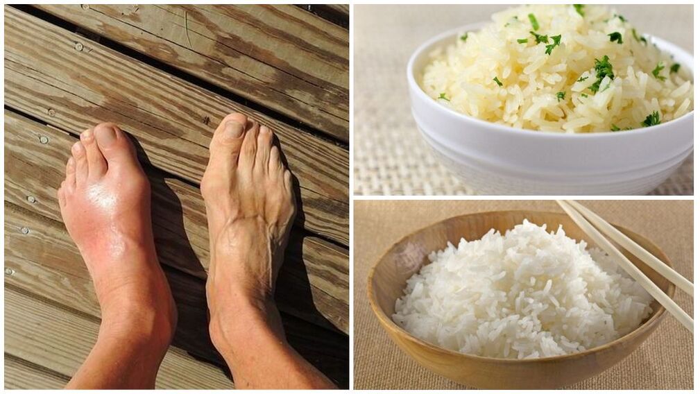 A rice diet is recommended for patients with gout. 